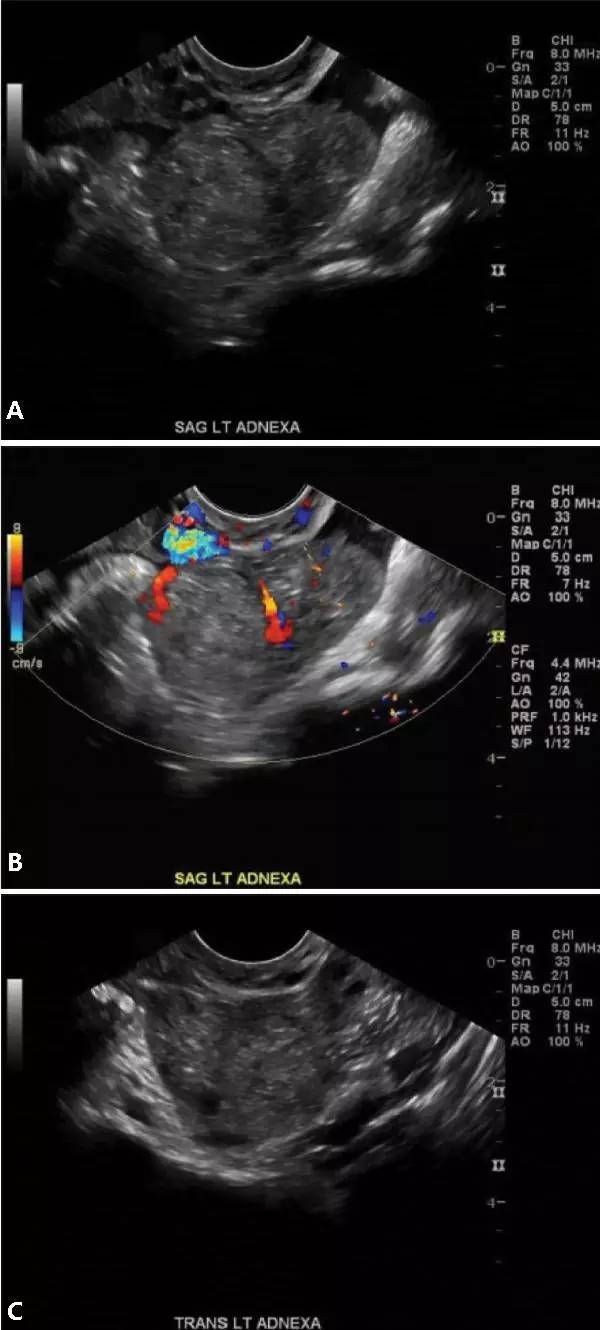 综述:全面掌握异位妊娠的超声表现