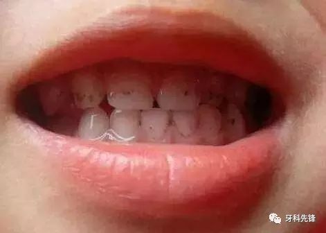 孩子牙齿有黑点怎么办