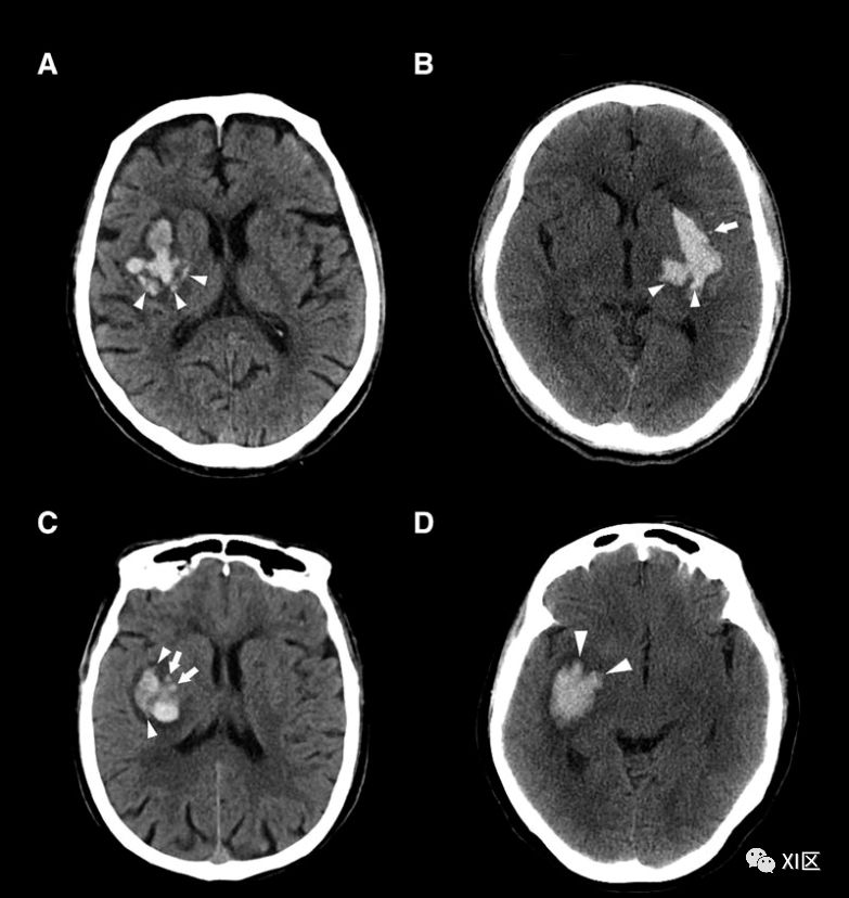 ct图像中脑出血血肿扩大的十个征象(上)