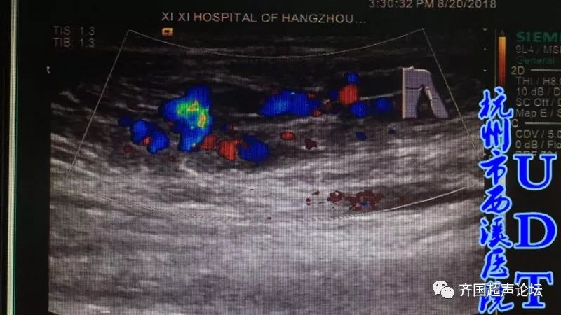 我院日常学习课程: 看完后有20个病例,有空的可以看看: 血管球瘤  中