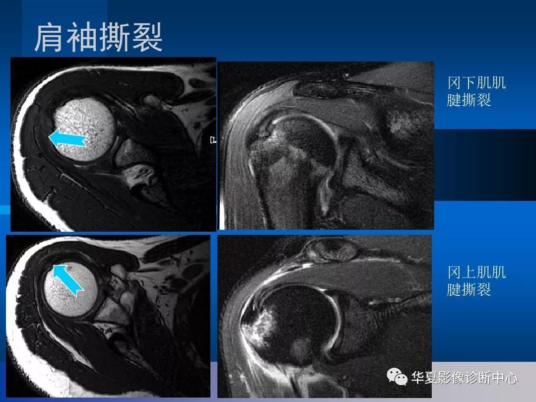 影像基础肩关节的影像解剖与mri附关节实物图