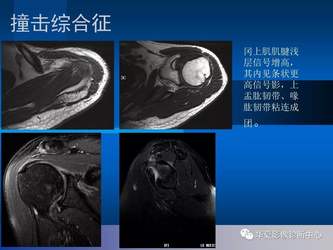 【影像基础】肩关节的影像解剖与mri(附关节实物图)