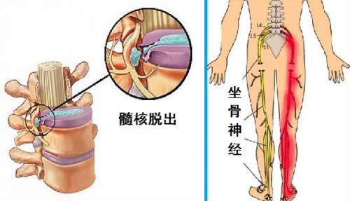 腰疼是不是又腰间盘突出了?