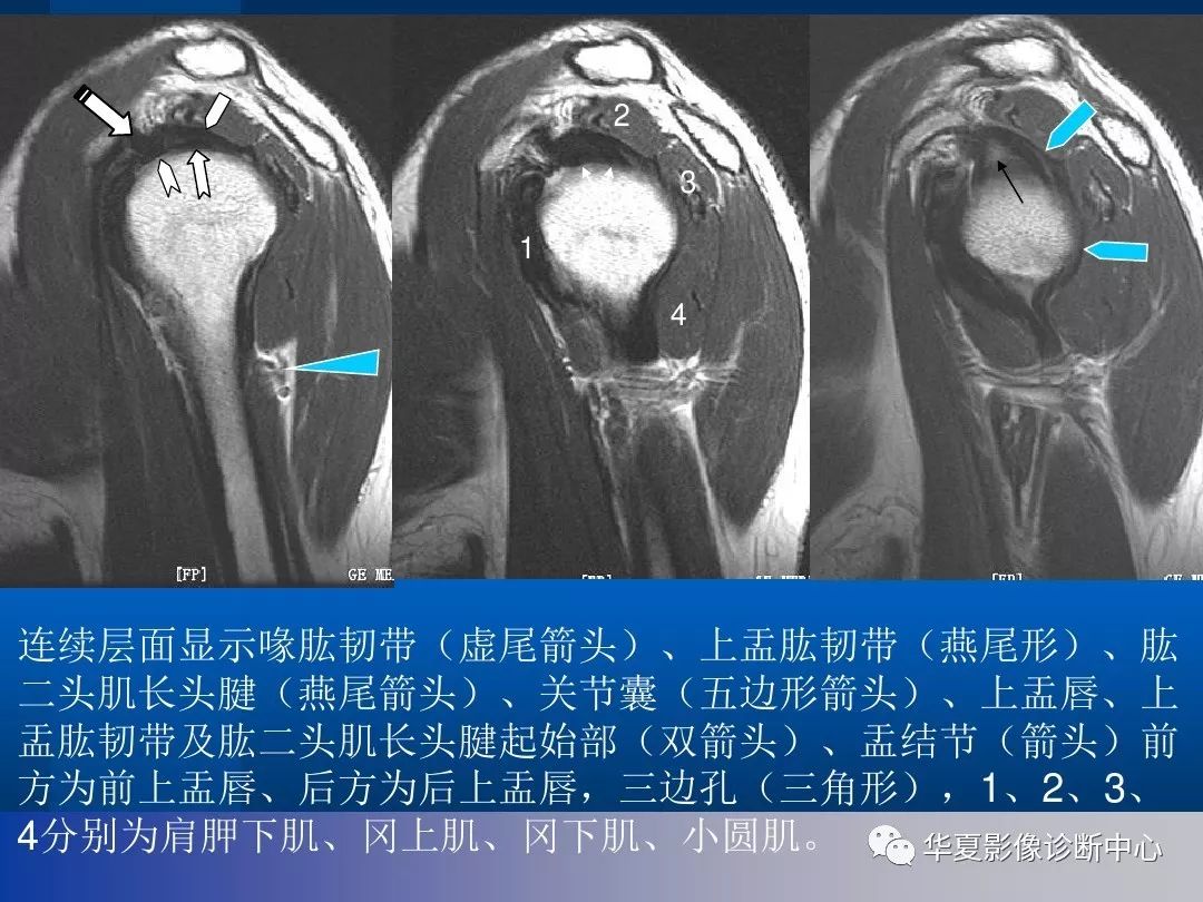 影像基础肩关节的影像解剖与mri附关节实物图