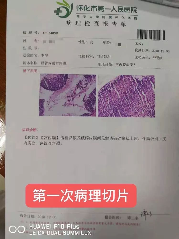 李氏砭法|砭法刮走子宫内膜癌前病变