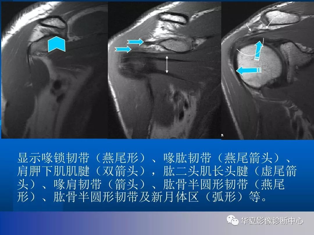 【影像基础】肩关节的影像解剖与mri(附关节实物图)