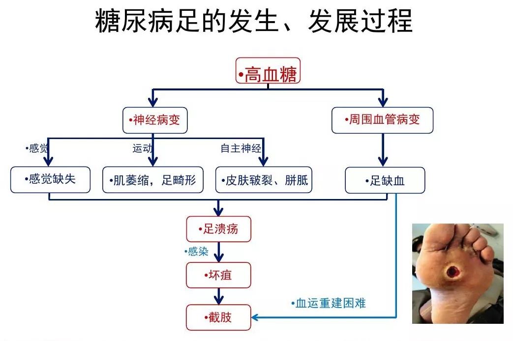 那些年,我们治疗过的糖尿病足.