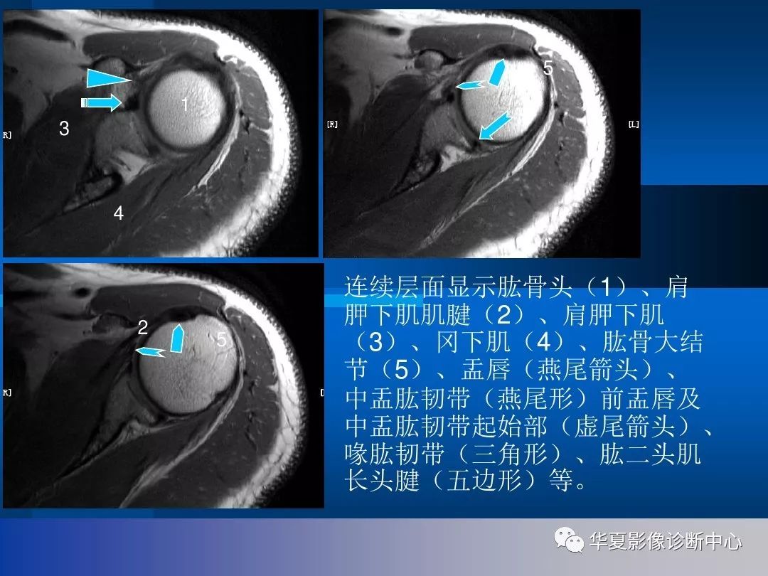 影像基础肩关节的影像解剖与mri附关节实物图