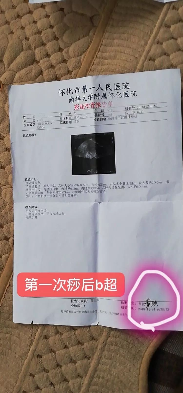 刮痧后第三天去体检报告,结果出来有问题: 子宫内膜出事了,是癌前病变