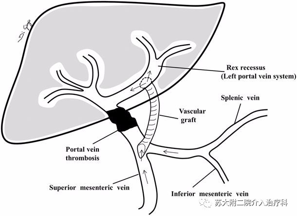 左肝内门静脉分流术(chen et al