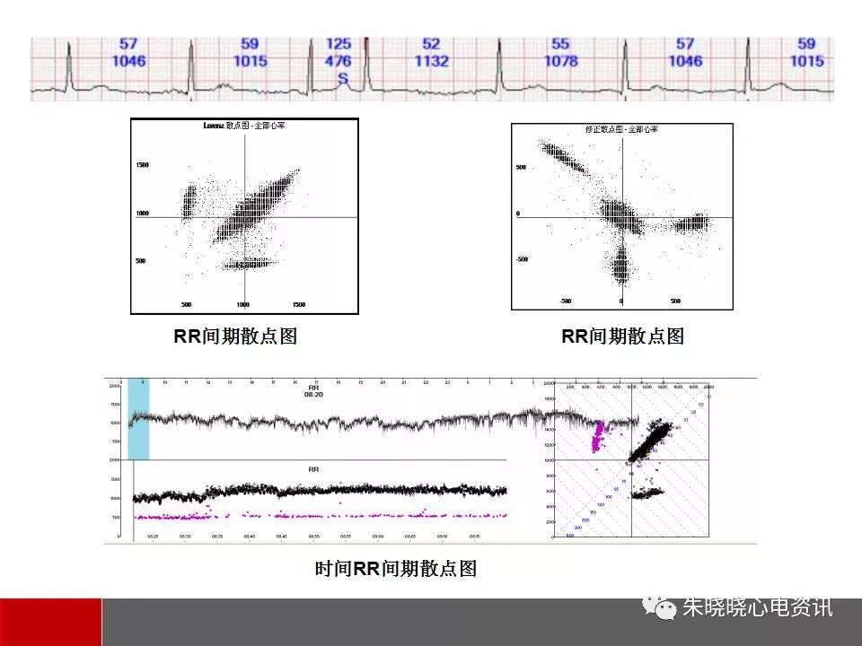 李方洁老师散点图系列之七:心电散点图及常见类型构图