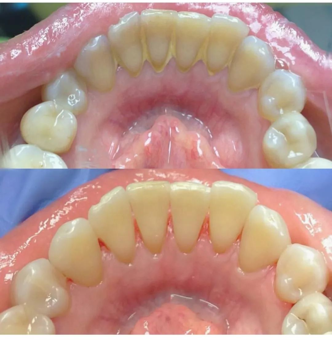 拔牙后七天窟窿恢复图解（拔牙后最怕的是"牙洞"的恢复期！需要多久才能愈合？） | 说明书网