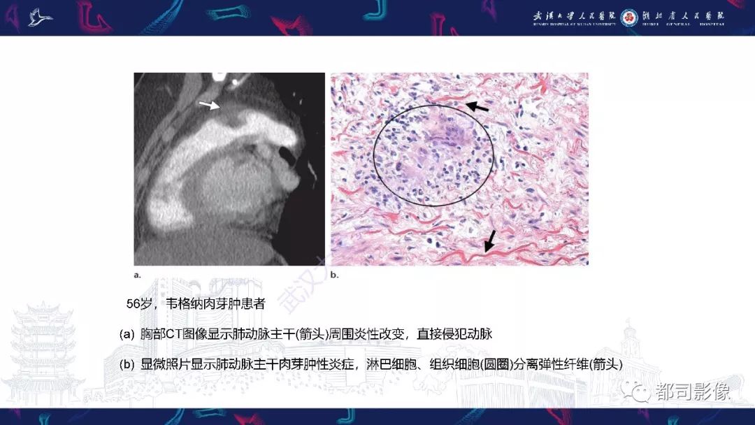 韦格纳肉芽肿典型与非典型胸部ct表现