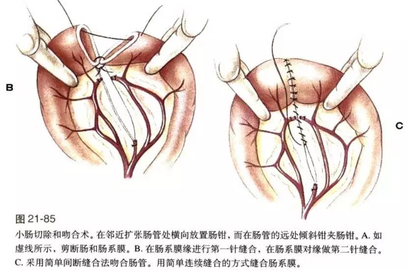 图4:小肠切除及吻合术图3:简单连续缝合图2:肠壁全层缝合图1:闭合位置