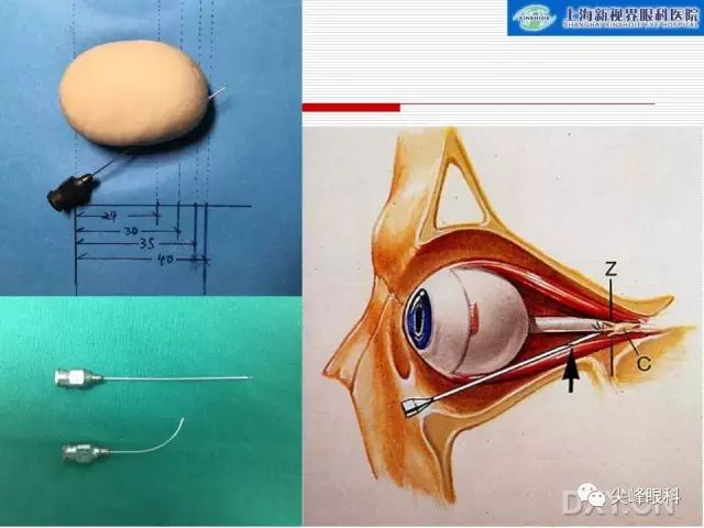 改变方向,向眶尖部刺入,这个时候你就不难理解球后注射针头可能刺入