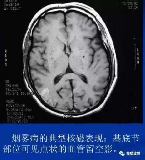 烟雾病的ct及mri表现