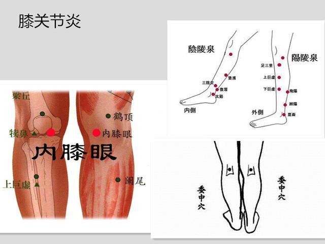 天宗穴髋关节炎,辐照穴位:环跳穴,阳陵泉腕关节炎,辐照穴位:踝关节炎