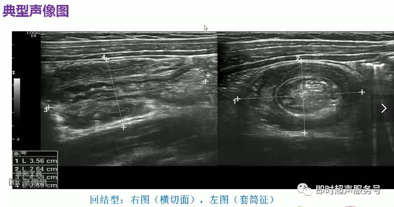 小儿腹盆腔疼痛超声之肠套叠