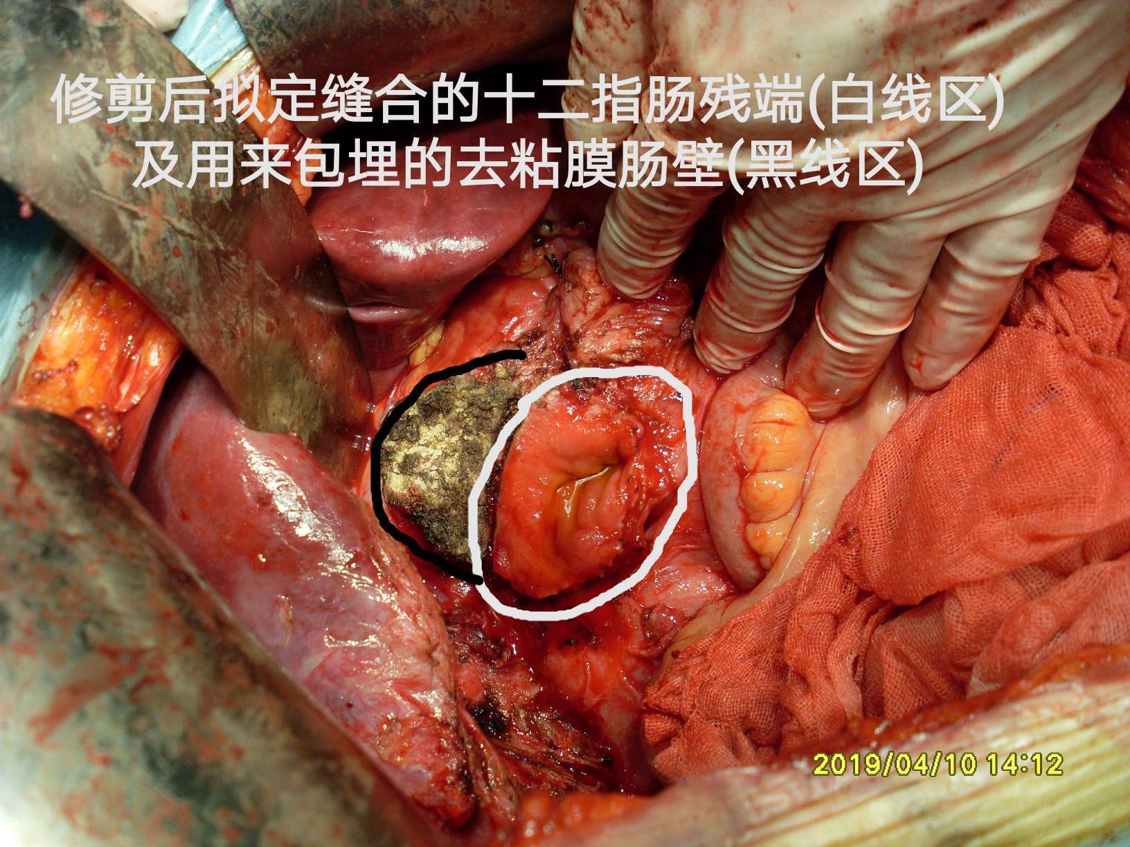 病例(40)--结肠肝曲粘液腺癌突破肠管向外生长! (原创