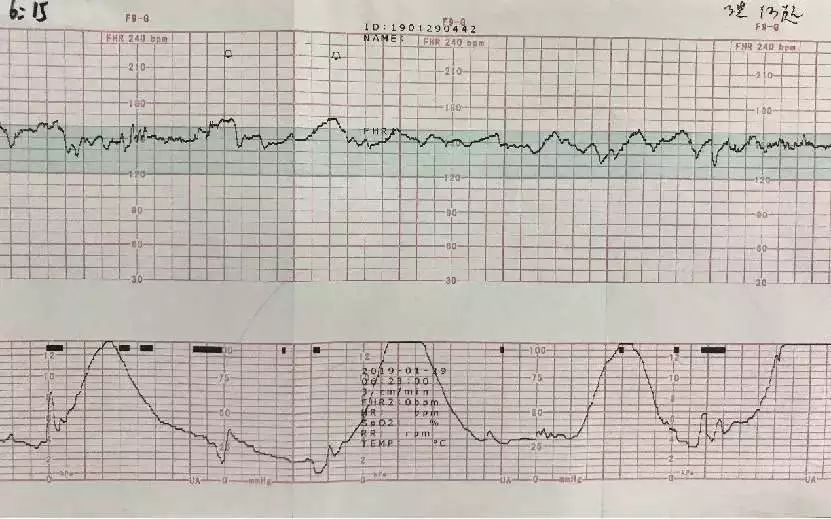 1月29日6:15,宫口开3cm,胎膜自行破裂,胎心监护显示中等变异.
