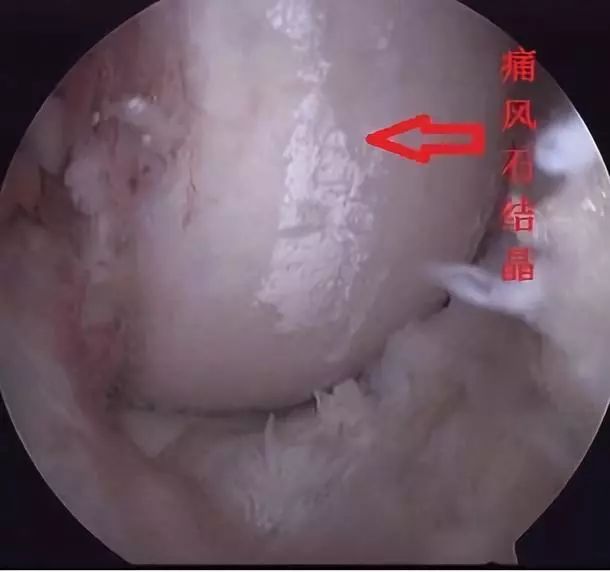 痛风膝盖肿痛怎么办