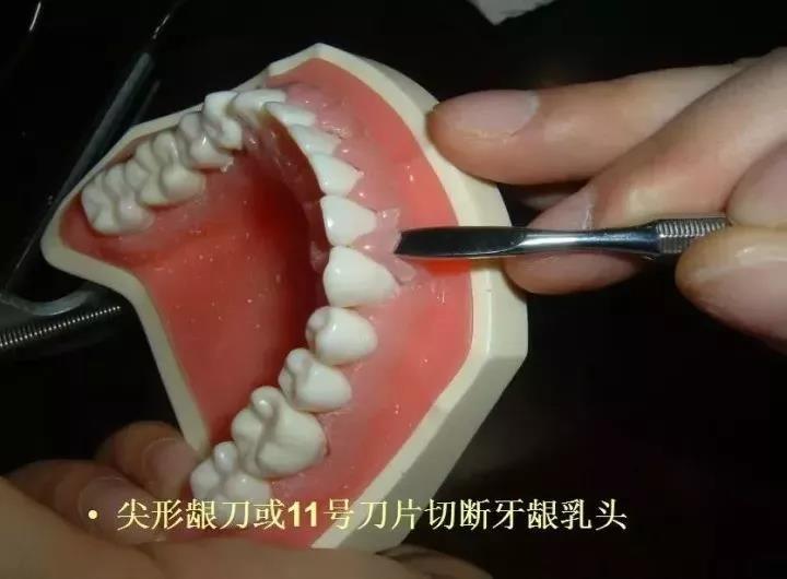 牙医必备技能之牙龈切除术