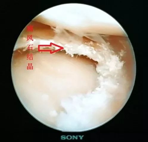 痛风膝盖肿痛怎么办