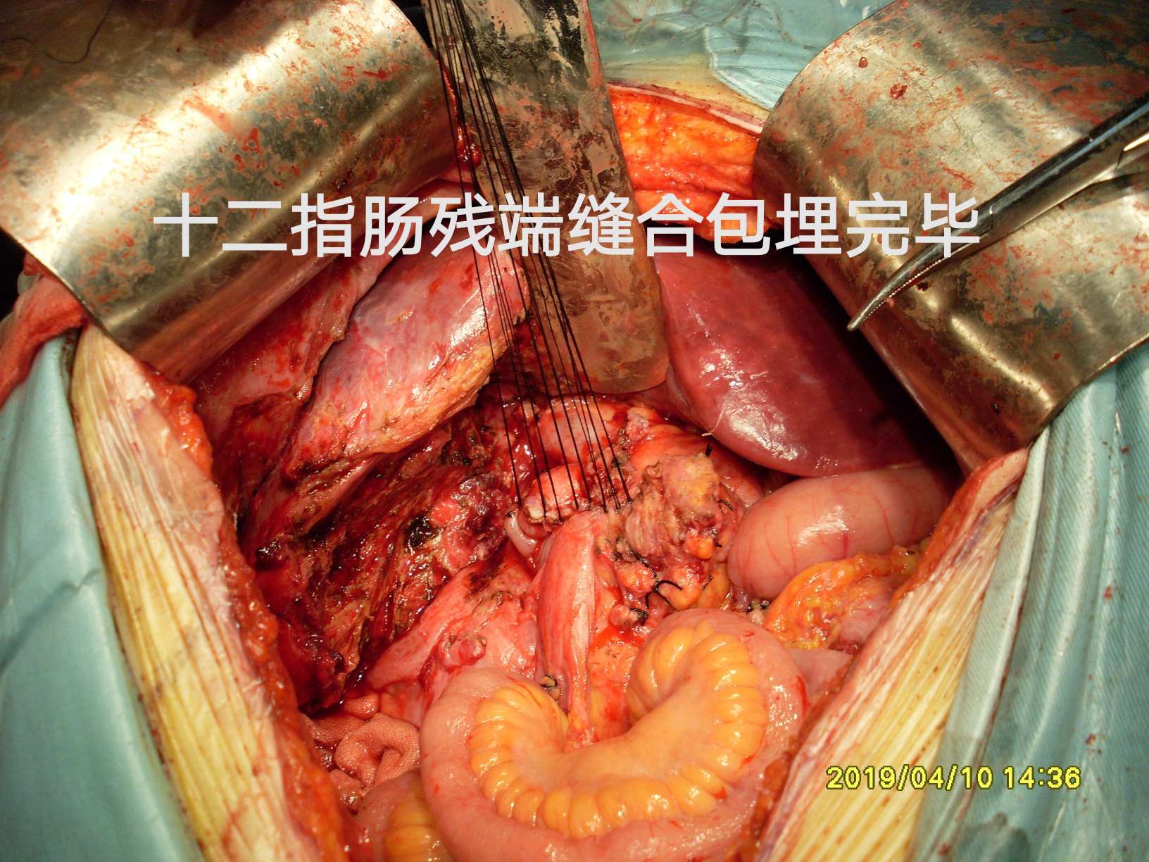 病例(40)--结肠肝曲粘液腺癌突破肠管向外生长! (原创