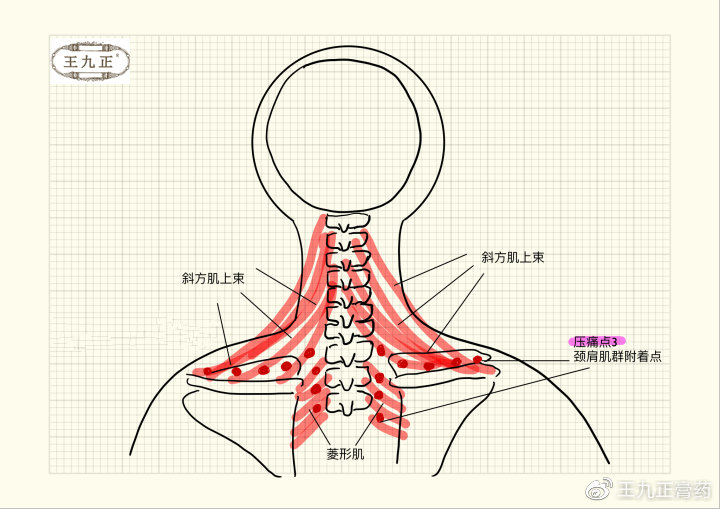 第三个区域为背后肩部和颈后侧的交界区域和锁骨上窝和颈部前侧的交界