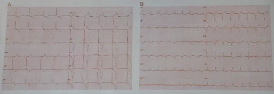 即sv1/sv2 rv5/rv6>40mm(男)或>35mm(女); hcm患者左室心尖部室壁瘤的