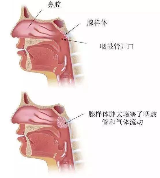 孩子总爱清嗓子,别忽视了,可能是这个病作祟!