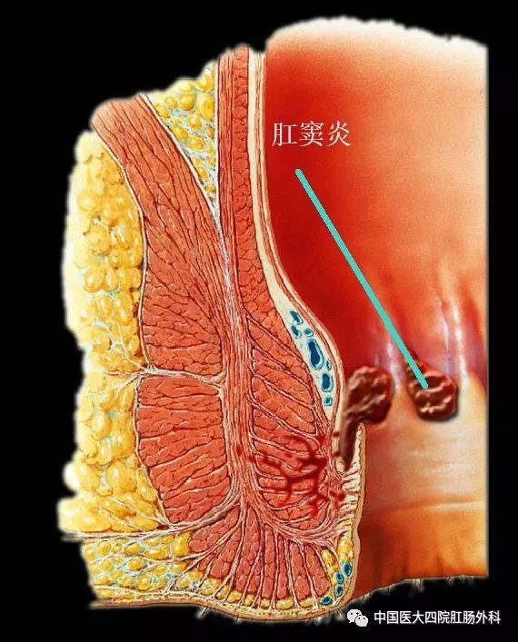 肛窦炎是肛窦(或称肛隐窝,肛门瓣发生的急慢性炎症,又称肛隐窝炎.