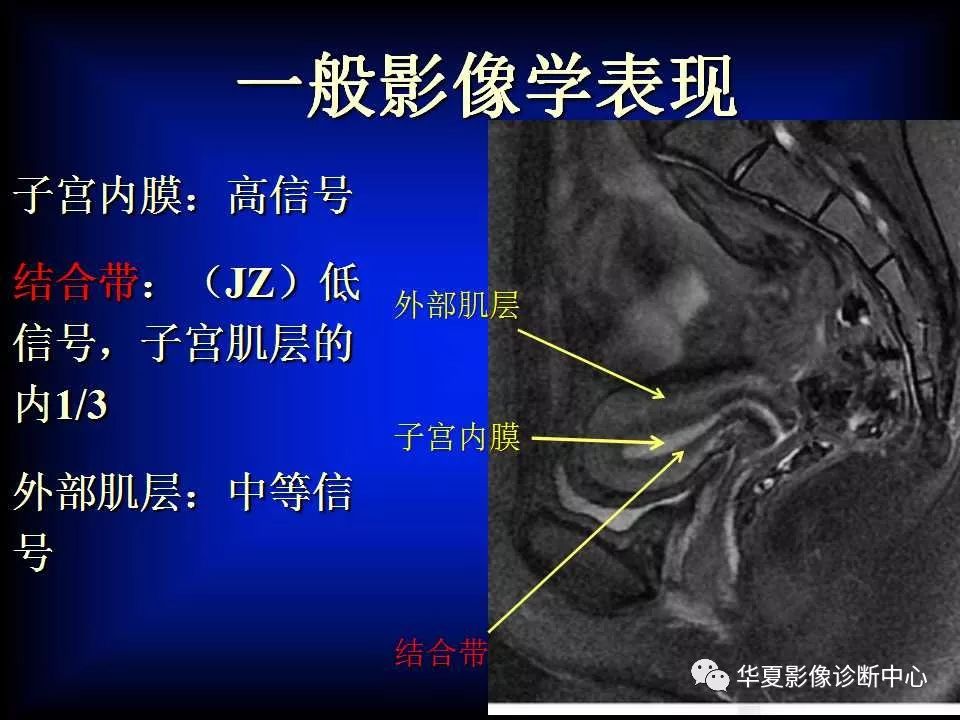 子宫腺肌症磁共振诊断