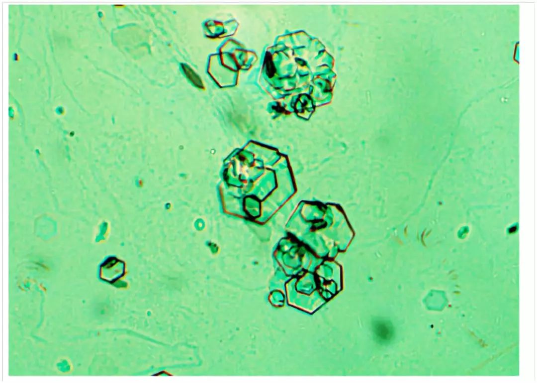 37.偏振光显微镜下关节液中负性双折光尿酸盐针状结晶-现代风湿性疾病·-医学