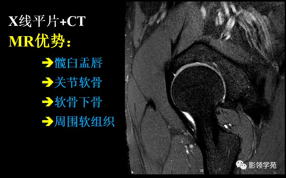 髋臼盂唇损伤读片方法髋臼盂唇损伤读片方法---冠状位fs-t2wi返回搜狐