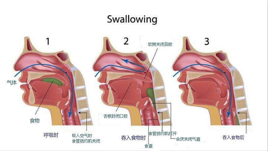 食物误入气管怎么办