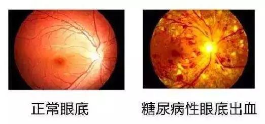 血糖高眼底出血怎么办