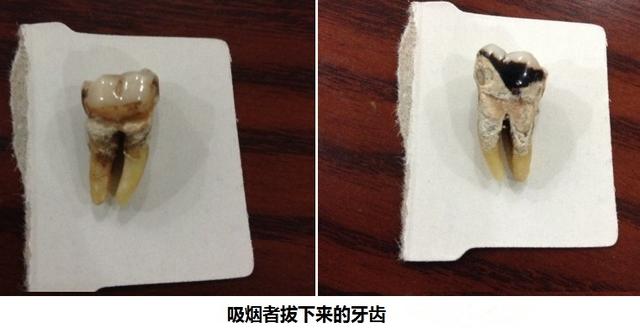 吸烟牙齿变黄怎么办