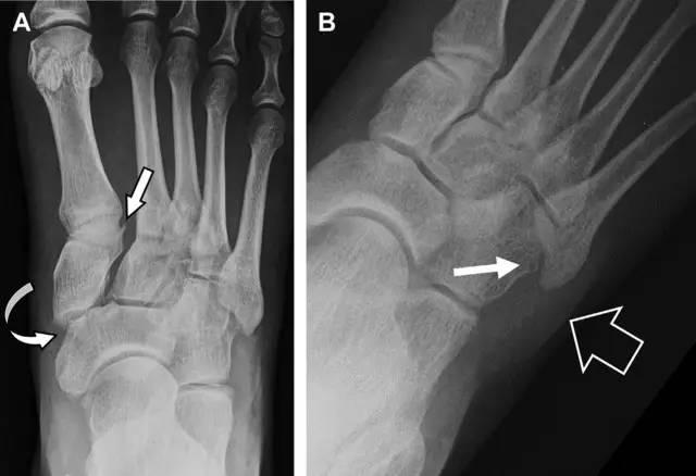 需注意,骨折在靠近内侧楔骨处(箭头);b 外侧跗跖关节损伤伴随从骰骨