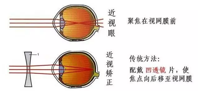 年轻时近视眼老了还会患上老花吗