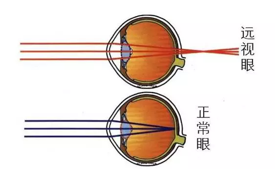 年轻时近视眼老了还会患上老花吗