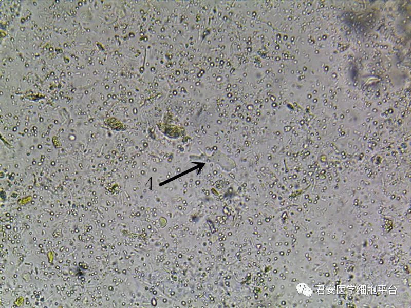 阿米巴样人芽囊原虫