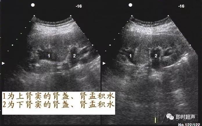 重复肾超声图解