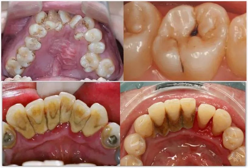 这种牙菌斑洗牙也挽救不了