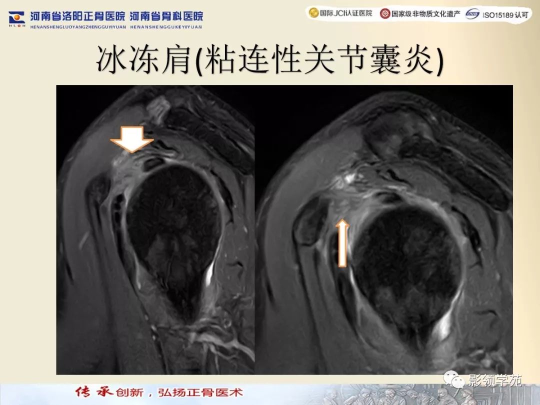 特异性95% 炎性期时腋囊及肩袖间隙内信号增高对诊断粘连性关节囊炎更