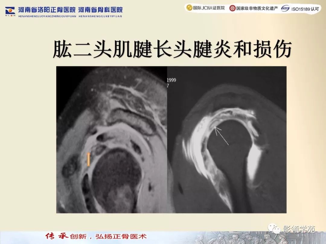 经典肩关节mri规范化扫描及相关病变影像学诊断