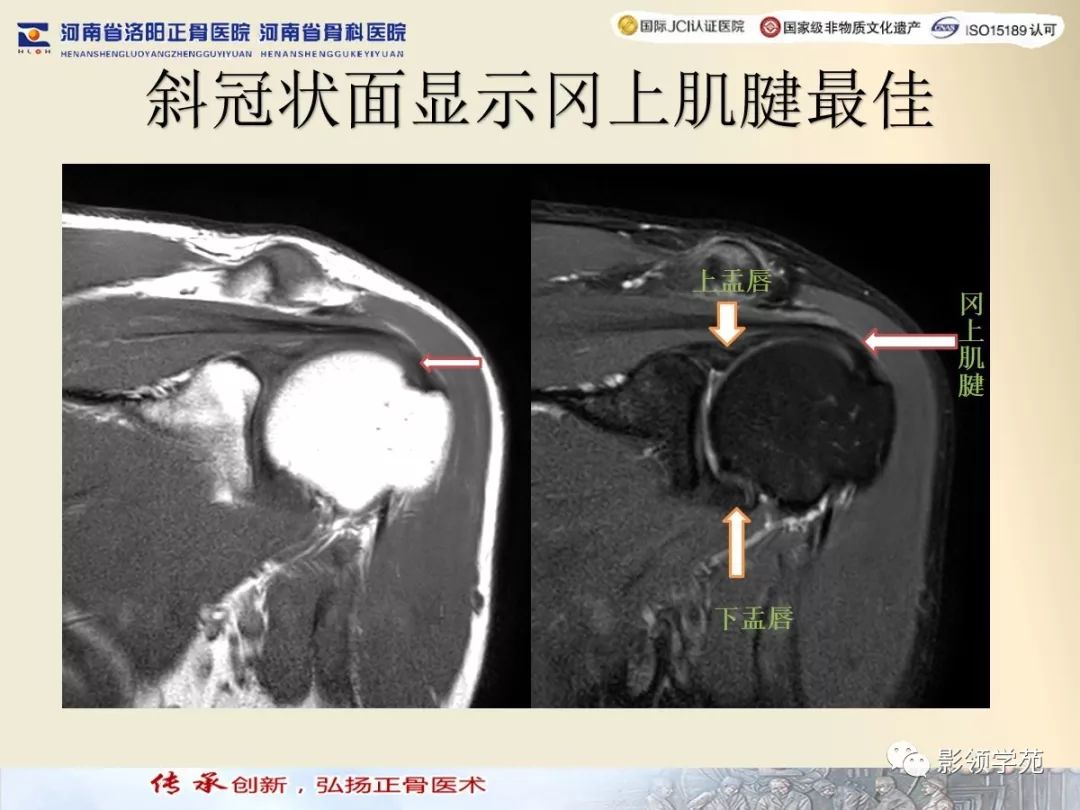 肩关节的影像解剖与MRI（附关节实物图） - 好医术早读文章 - 好医术-赋能医生守护生命