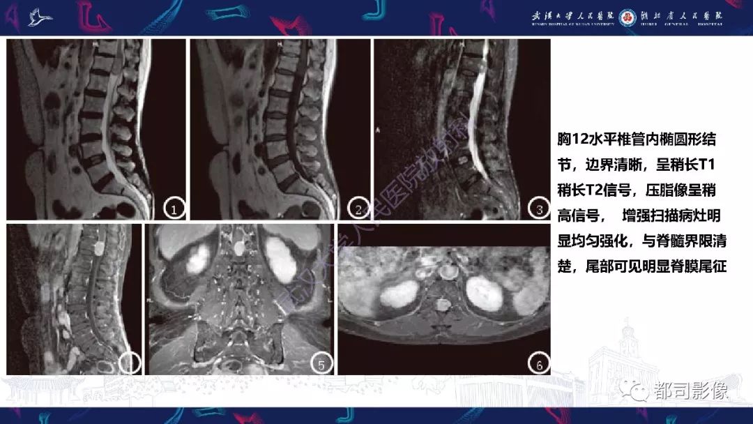 少见脊膜瘤影像诊断