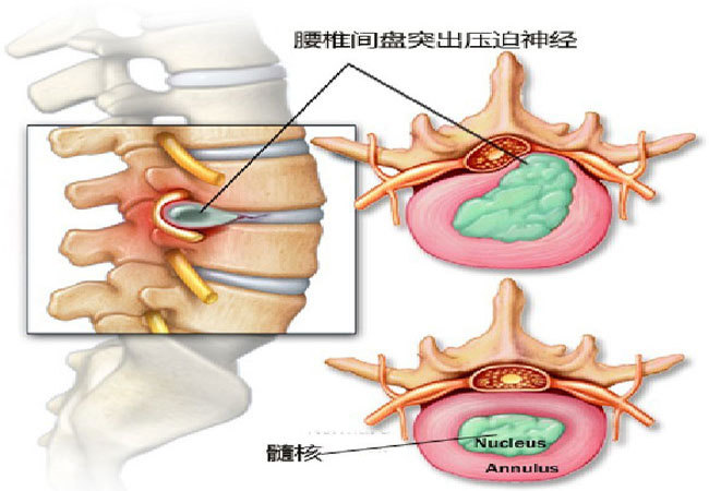 长圆针治疗腰椎间盘突出是什么原理