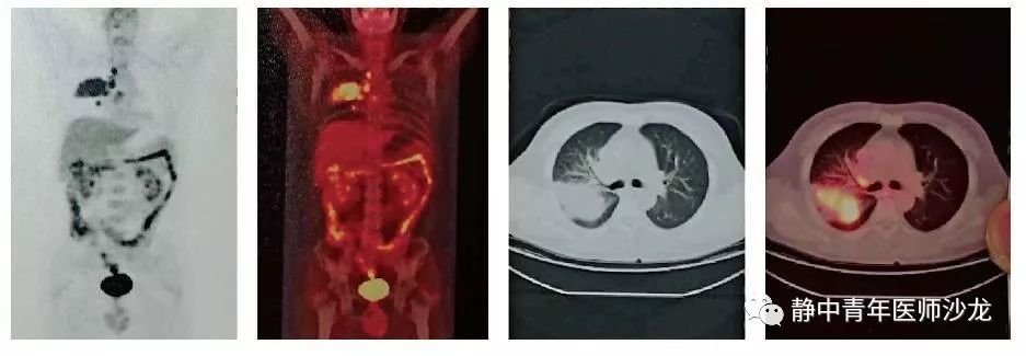 合并肺隐球菌的肺癌一例